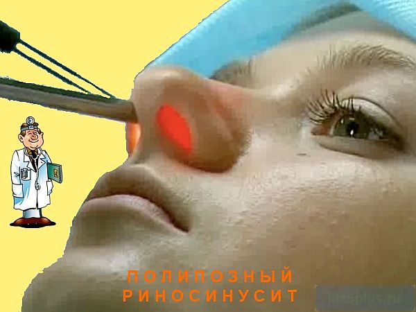 alt="Лечение полипов носа"