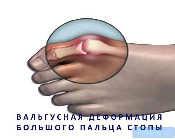 alt="Шишка на большом пальце ноги"