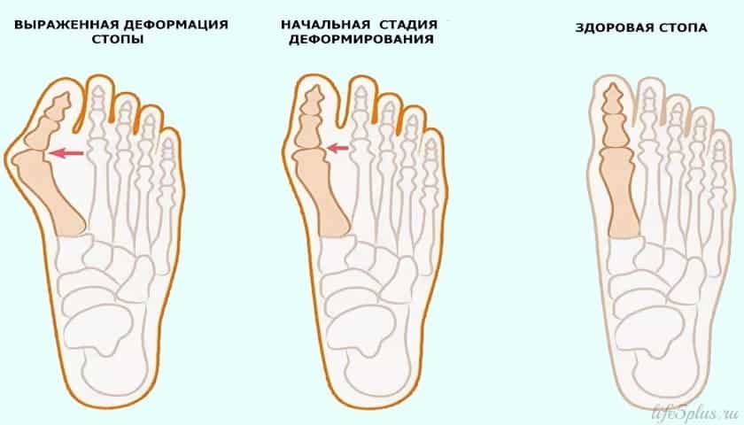 Вальгусная деформация первого пальца стопы